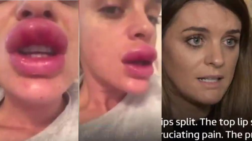 Fue a una fiesta de bótox y terminó con los labios deformes