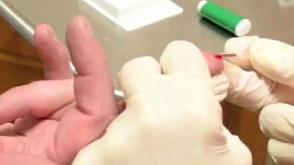 Se cuadruplicaron los casos de sífilis en Argentina