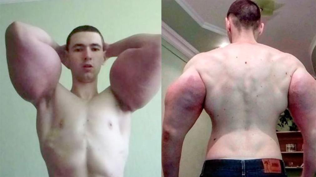 Qué es y que provoca el Synthol, la sustancia que se inyectó el “Popeye” ruso