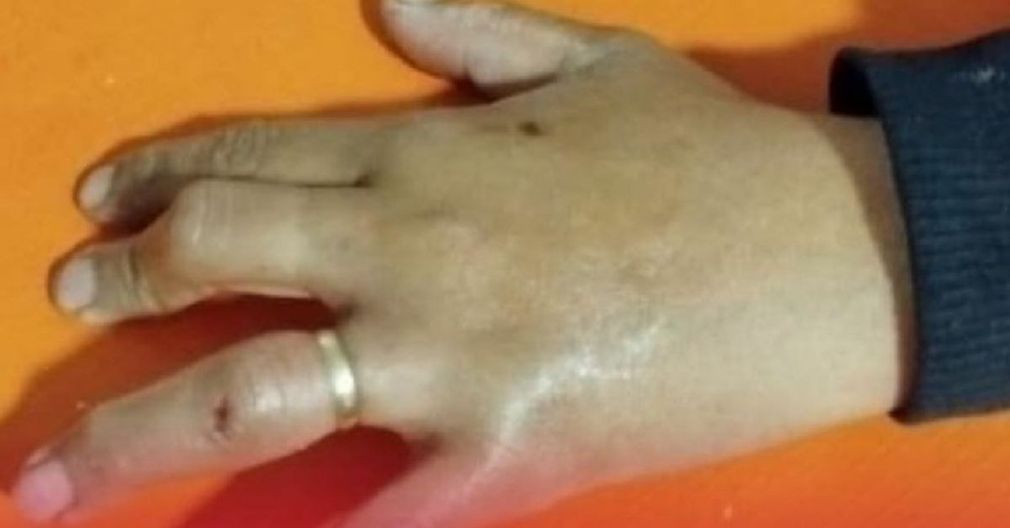 奧蘭發生事故後,消防隊員成功挽救了一名婦女的手指